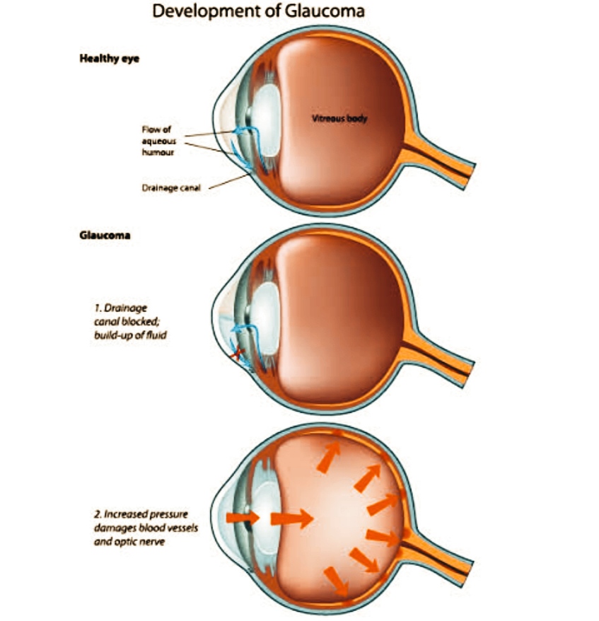 Glaucoma: A must know Eye disease 